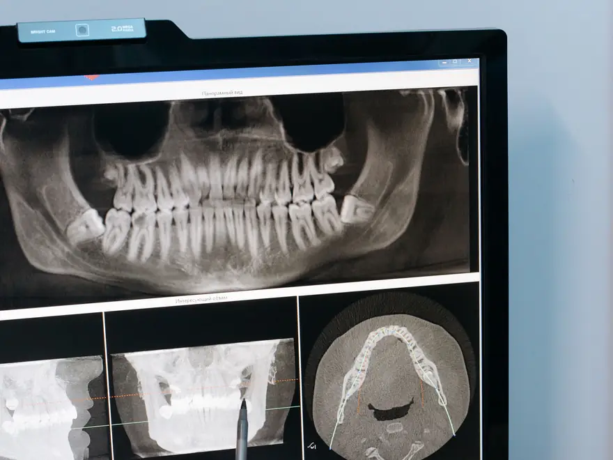 Surgical Orthodontics at Whitehorse Orthodontics